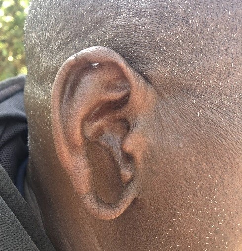 マサイマラに住むマサイ族の男性（56歳）の耳。耳たぶが大きく下に垂れている。昔はこの耳たぶに沿って装飾品を付けていたという（2022年7月22日、筆者撮影）