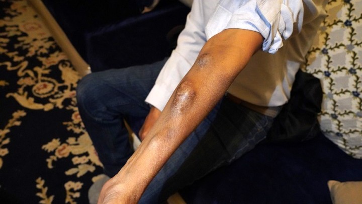 モハメド・ブータバーさんは2006年に警察車両にひかれて以来、人工透析が必要となった。人工透析を長年受けてきたため、腕は膨れ上がっている